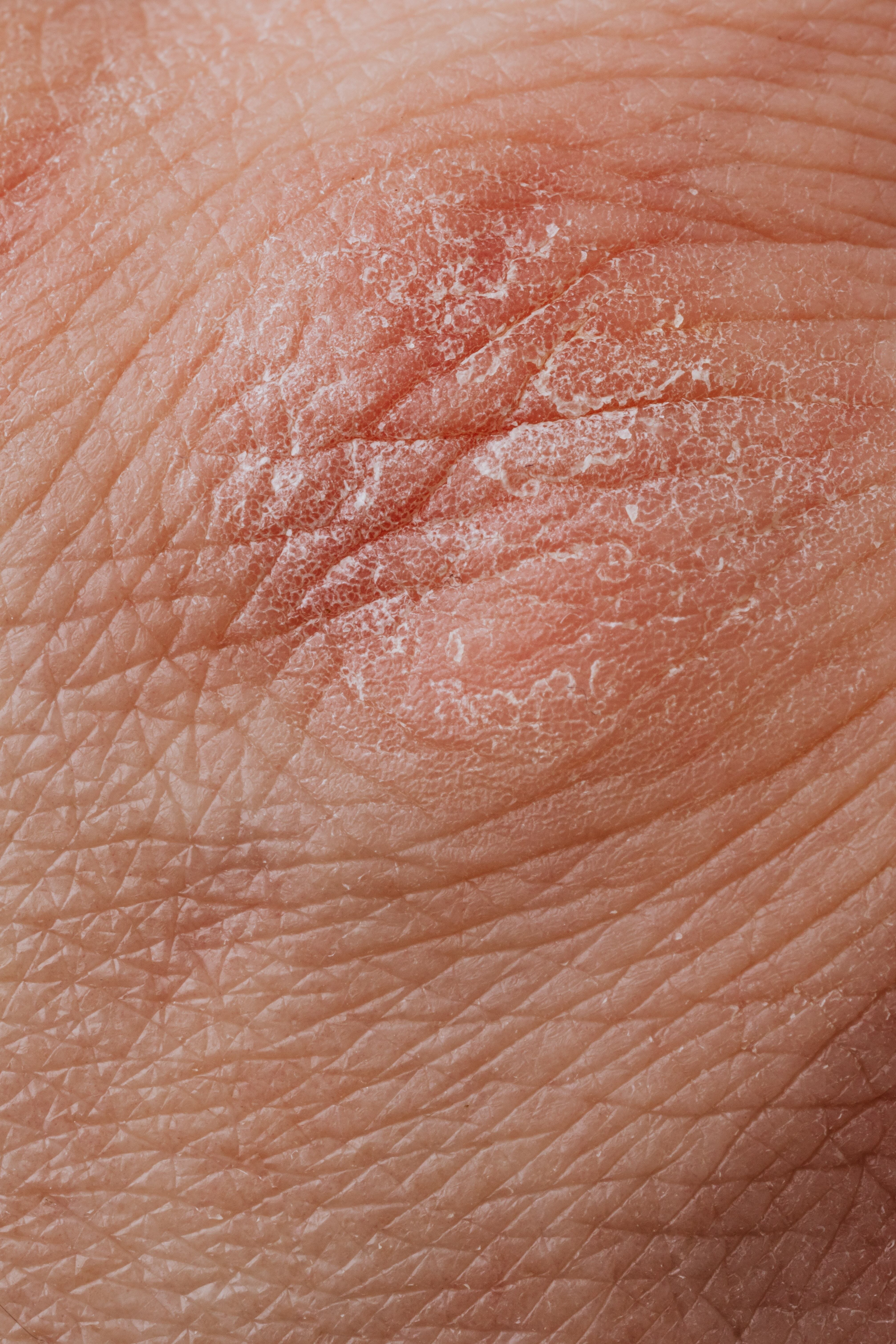 Urticaria. Si después de consumir mariscos, fruta o algún lácteo, comienzan a salirte granitos en el cuerpo, acompañado de mucha comezón, posiblemente se trate de una alergia.